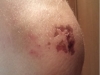 Wombat elbow damage