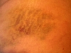 Sharon bruise 1