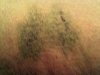 Sharon bruise 2