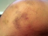 Sharon bruise 3
